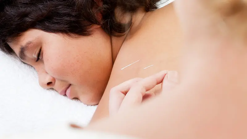 boy getting acupuncture