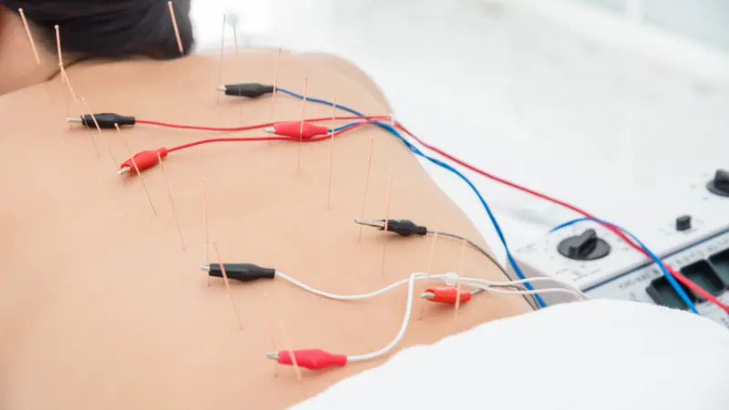 Woman receiving acupuncture with electrical stimulator at back