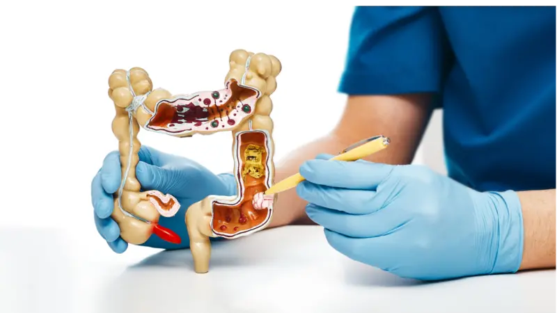 Gastroenterologist pointing pen at colon tumor using an anatomical model for medical education