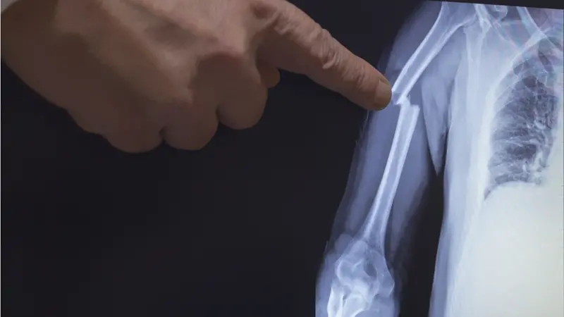 On the monitor screen is displayed an X-ray of a humerus fracture with the hand of a doctor pointing to the fracture