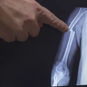 On the monitor screen is displayed an X-ray of a humerus fracture with the hand of a doctor pointing to the fracture